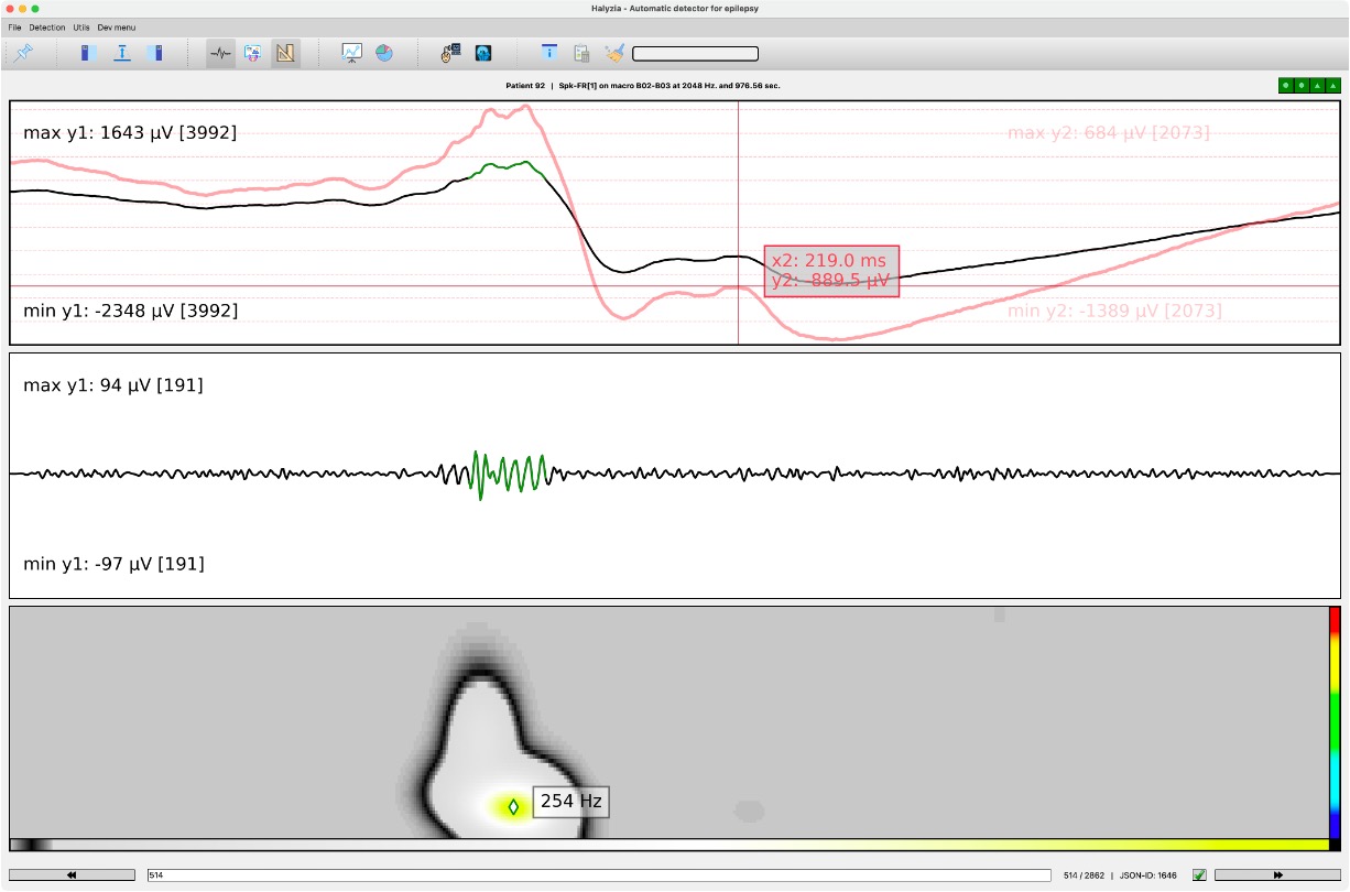 Halyzia - Suite logicielle d'analyse EEG intracérébrale