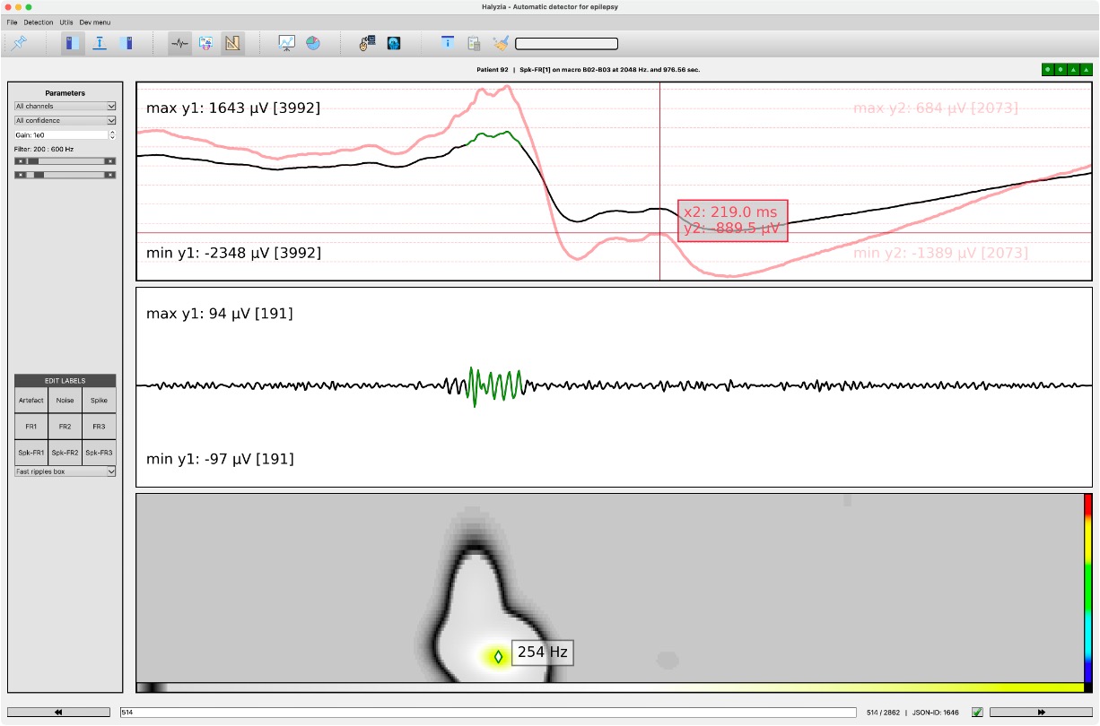 Visualisation EEG